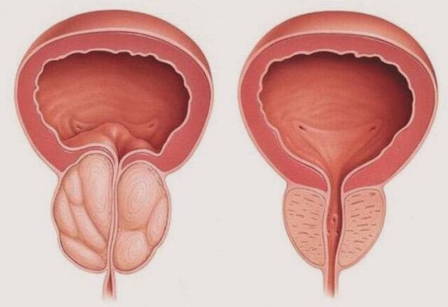 prostate saine et enflammée avec prostatite