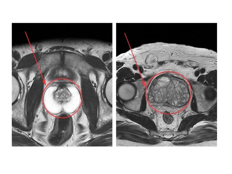 Comparaison d'une prostate saine (à gauche) et enflammée (à droite) sur des images IRM